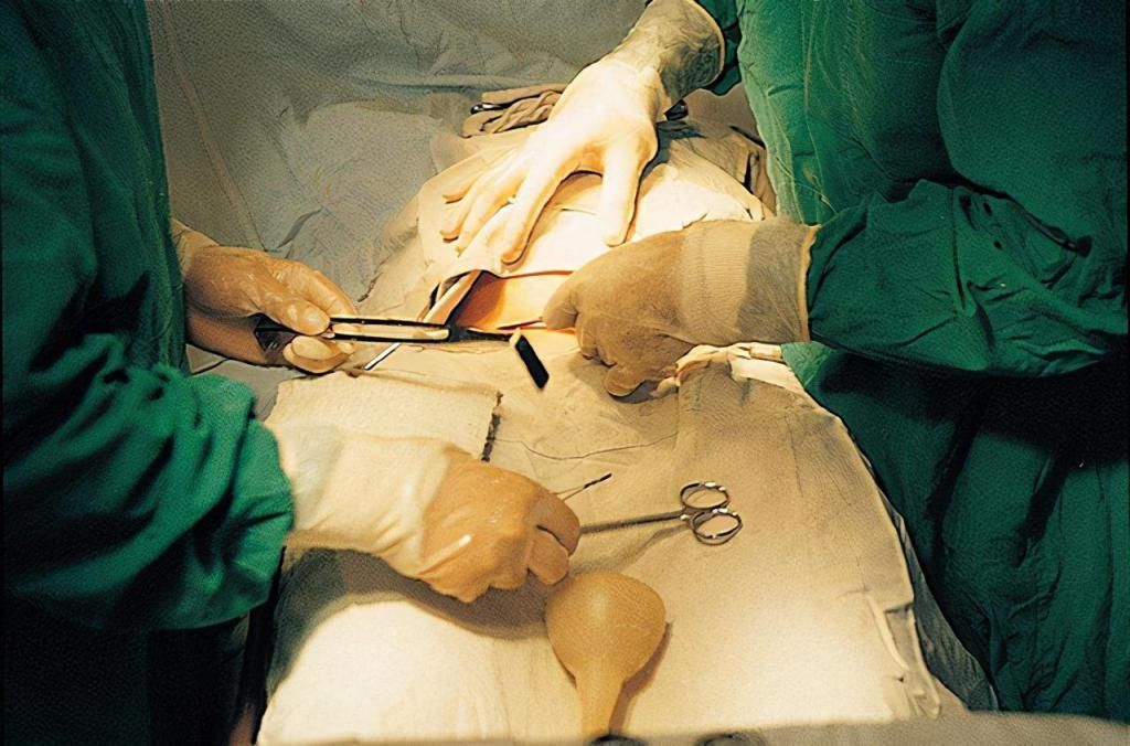 剖腹产|顺产和剖腹产,哪个更受罪过来人一个先苦后甜,一个先甜后苦