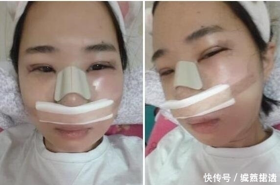 小脸|小脸确实更可爱,看完整容过程,只觉得满屏的疼痛