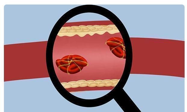 心脑血管|忠告：2味调料尽量少吃，可能是血栓的“温床”，常吃血管受不了