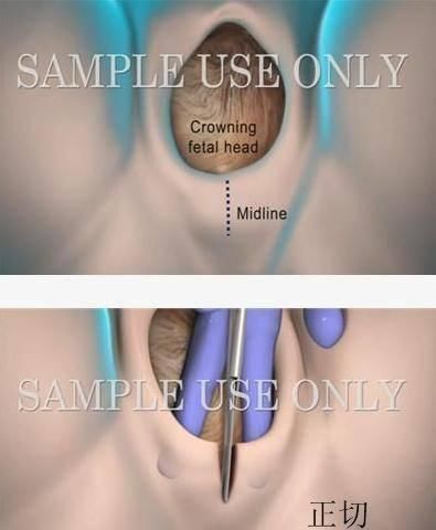 宝妈|顺产除了侧切,还有另一种切法,出血少疤痕浅,关键是痛感也小