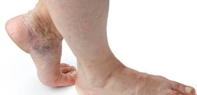 甘油三酯|血管堵不堵，2个动作就知道45岁后常动“一处”，10秒畅通血栓