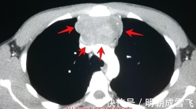 病人|癌症晚期病人差异这么大？有人可以5年以上，有人只有9天寿命？