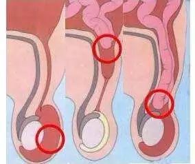 疝囊|疝气不善，家有老人的要注意了