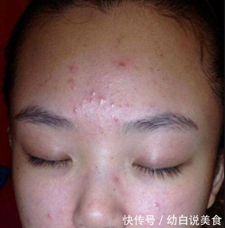 宫颈癌|21岁女子查出宫颈癌,医生皮肤3个异常,或不是过敏,建议了解