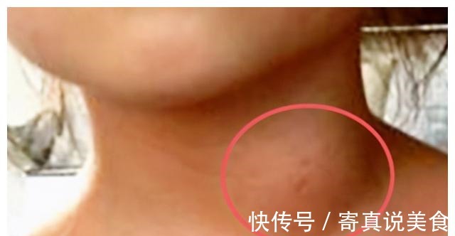 甲状腺|一家五姐妹全部得癌症，还是晚期，医生惋惜有些钱不能省