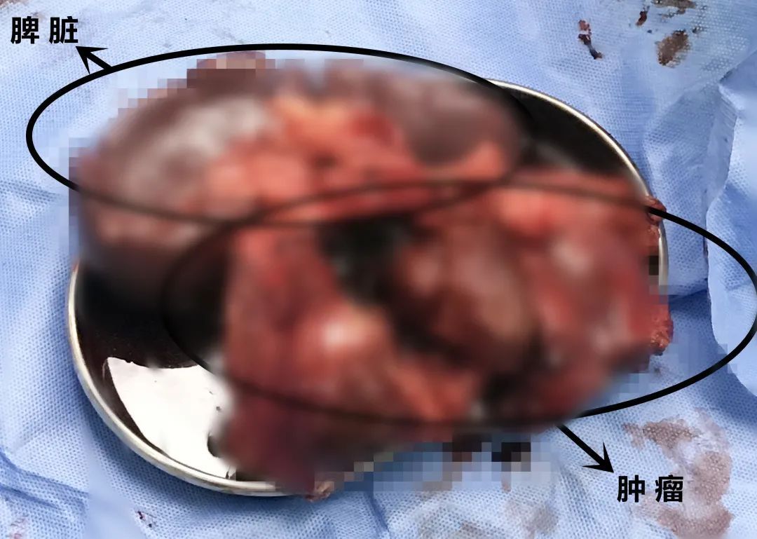 头晕|15公分!杭州大伯明明只是头晕,肚子里却查出“定时炸弹”!