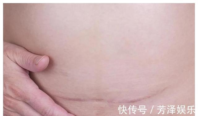 月子|分娩日记14没有羊水+绕颈两圈,胎盘功能三级,立即插队剖腹产