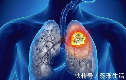 清洁工|5物是肺部“天然清洁工”，平时敞开吃，助你排毒清肺一身轻