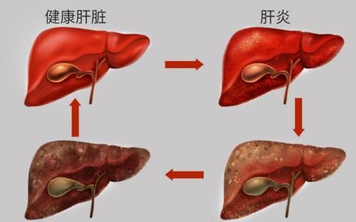 肝硬化|河南50岁大姐,查出肝硬化,每日坚持吃菠菜养肝,后来怎么样了?