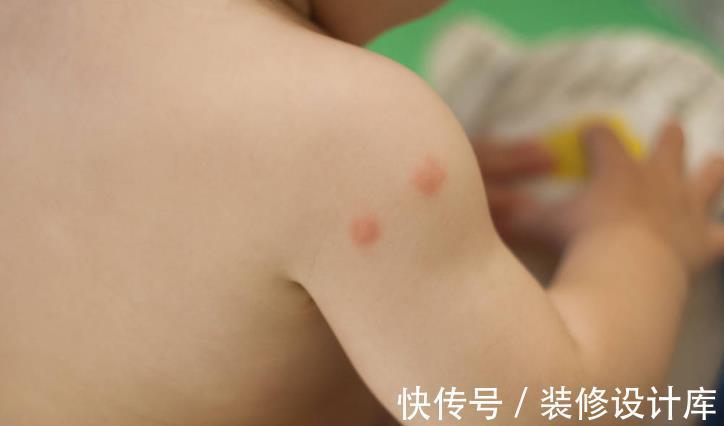 宝宝|宝宝被蚊子叮咬后,红肿长时间不消退,是怎么回事?该怎么办
