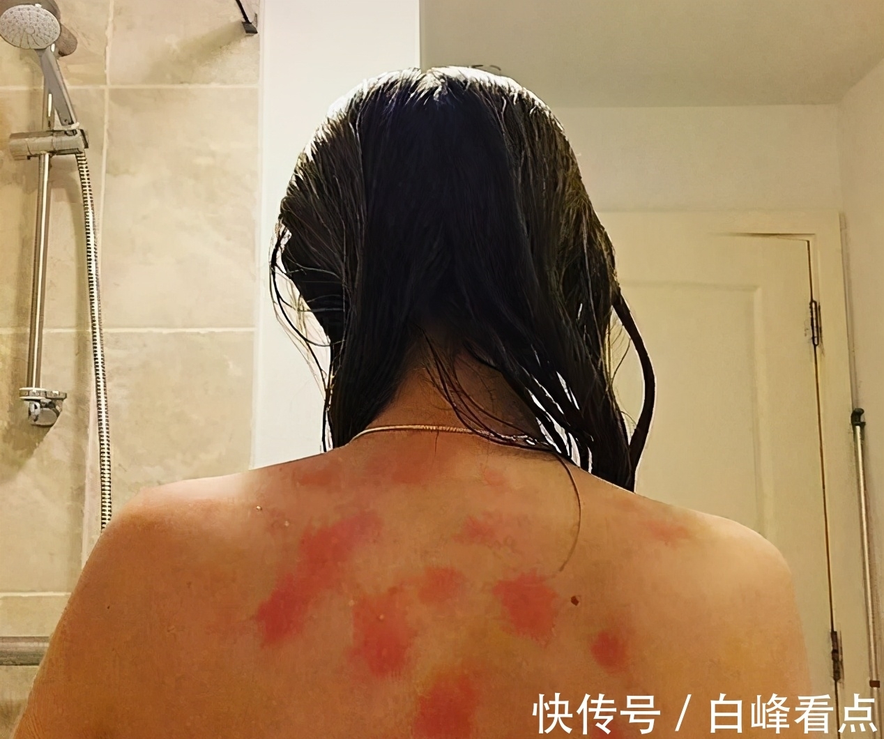 小姑娘|对水过敏的女孩,洗一次澡都可能要她的命,出汗流泪都痛苦