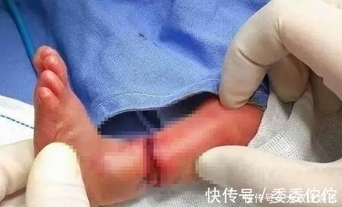 农药残留|胎儿在妈妈肚中被绑腿,出生后被告知要截肢,宝妈瘫地痛哭