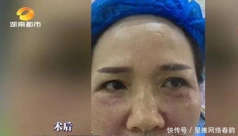 效果|长沙女子花费2万元去皱，结果法令纹依旧，院方：效果因人而异