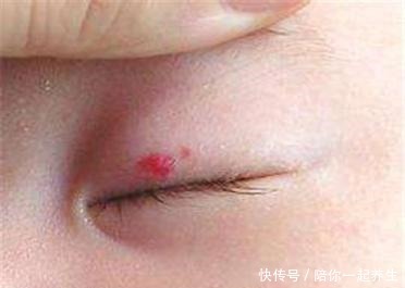 新生儿手臂生出“草莓斑”,宝妈以为碰了,医生检查后说要手术!