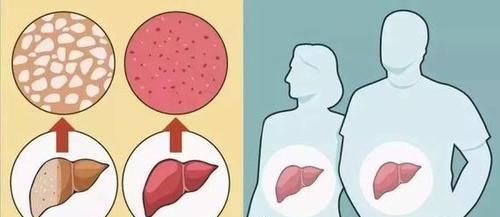 糖尿病|老中医教你“对症下药”,打通淤堵,疏肝化痰,消灭脂肪肝