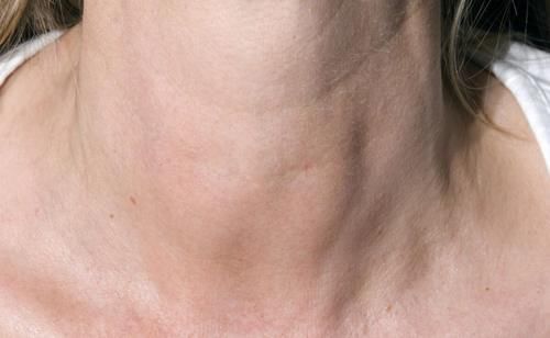 嘶哑|35岁女子甲状腺结节转癌，医生叹息：身体早有提醒，是她忽略了