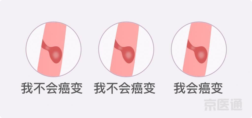 癌症|结节、息肉、囊肿是癌症先兆吗？北肿专家们说出了真相！