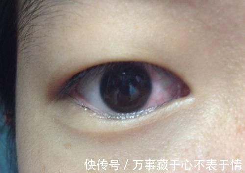 慢性肝炎|肝不好眼知道，两种迹象说明”肝癌“已经找上门，3招护眼更护肝