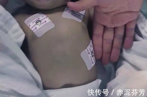 尿血|9岁男孩体内塞了56颗肾结石,只因天天吃这个,很多妈妈还在给孩子喂