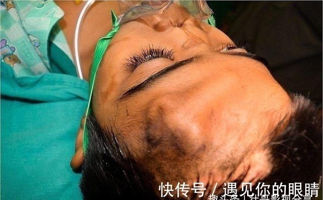 额头|国外小男孩鼻子长在额头上,看了他的经历,真是坚强的表率