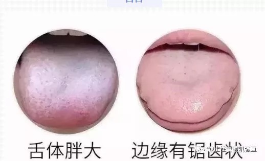 九窍|补脾，是一切疾病治疗的关键，生津润燥汤治疗干燥综合征就是如此