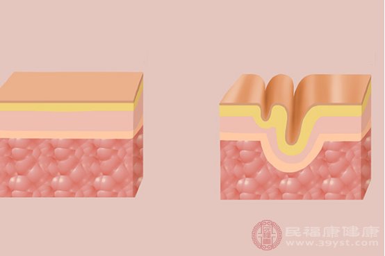 烫伤疤痕怎样去除