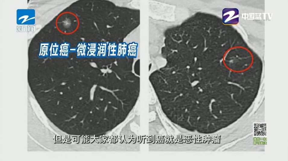 实性|这样的肺结节竟是癌前预告 你们的肺需要好好保护