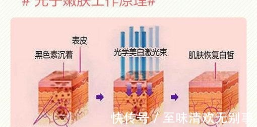 强脉冲光 水光针和光子嫩肤有什么区别!