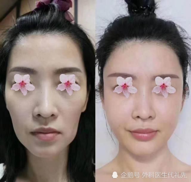 苹果肌|做脂肪填充之后,会下垂得更厉害?更容易显老?准备做面填的人来看看