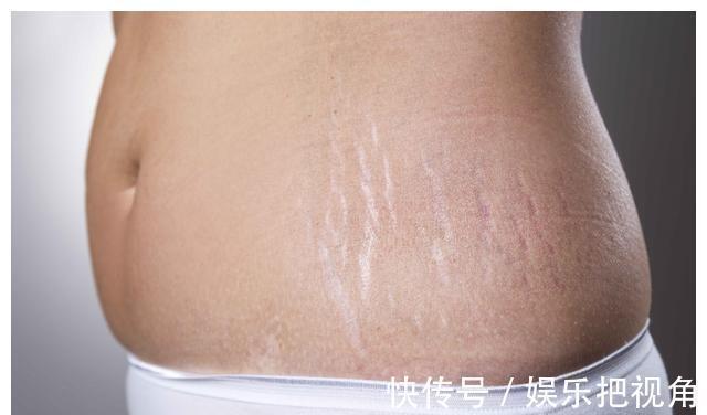 妇产科医生|女人如果多次剖腹产,肚子会变成什么样?看完觉得“头皮发麻”