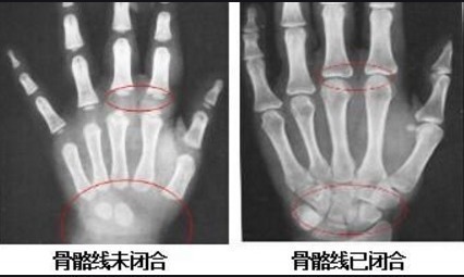 黄金期|男孩长高有2个“黄金期”，骨骼线闭合前都有机会，别放弃太早