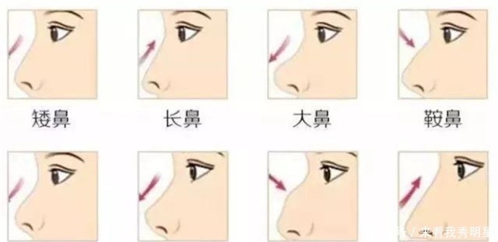 眼是美之窗，鼻是颜之魂；范芳医生谈国人常见鼻型及美学特点一