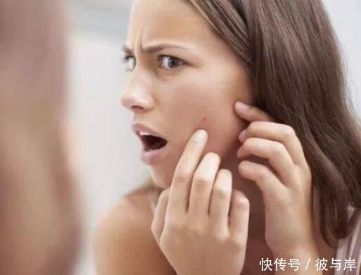 祛痘印|让你留痘印的5件事,很多人经常做!留下痘印能怪谁!