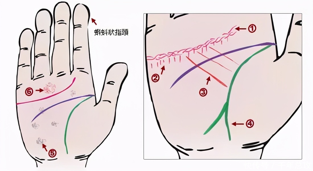  诊断|掌纹可以诊断肝癌、糖尿病、高血压、妇科病、脑溢血