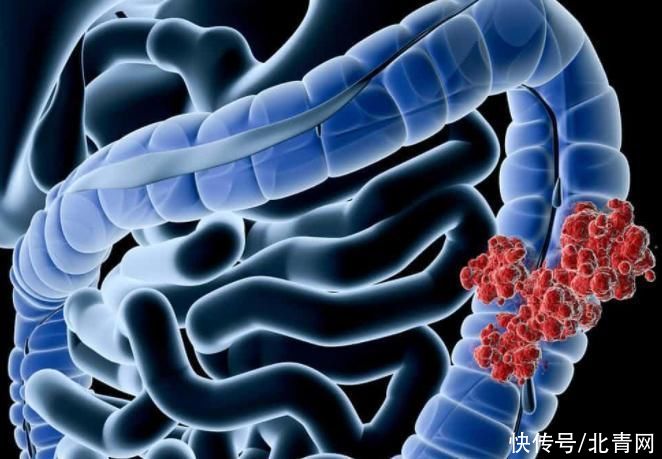 靶向治疗|结直肠癌危险系数高,医生:早发现仅需内镜治疗
