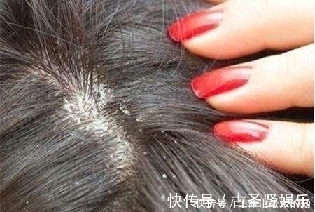 虱子|为什么头上会长虱子?真相原来如此,看完恍然大悟