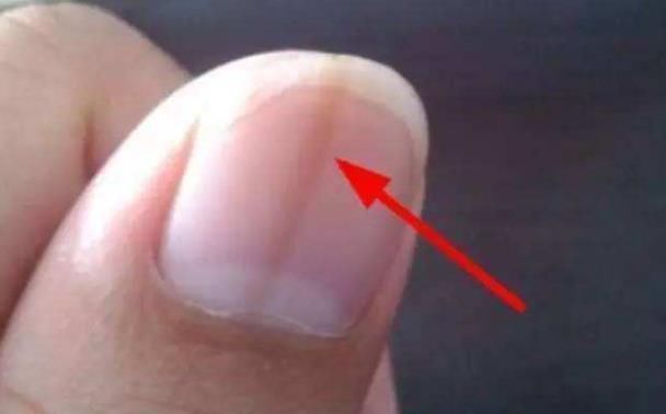 灰指甲|指甲上竖纹增多变黑怎么回事?可能是这4个问题,请自查一下!