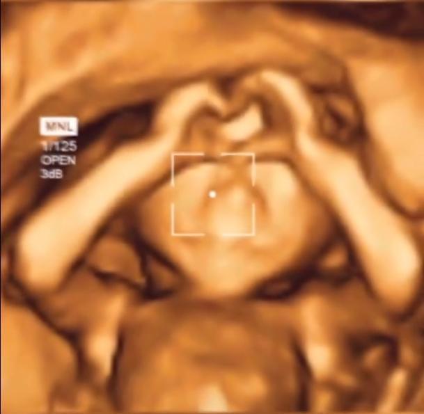 四维彩超|孩子腹中“比心”火了,四维彩超下的孩子动作暖心,医生:太有爱