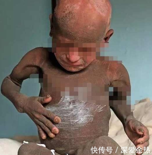 绝症|男孩得奇怪绝症,8岁时变成一尊石像,医院检查后大骂父母无知