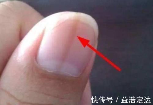缺铁性贫血|指甲上出现了竖纹?可能跟这4个健康隐患有关,别不当回事!