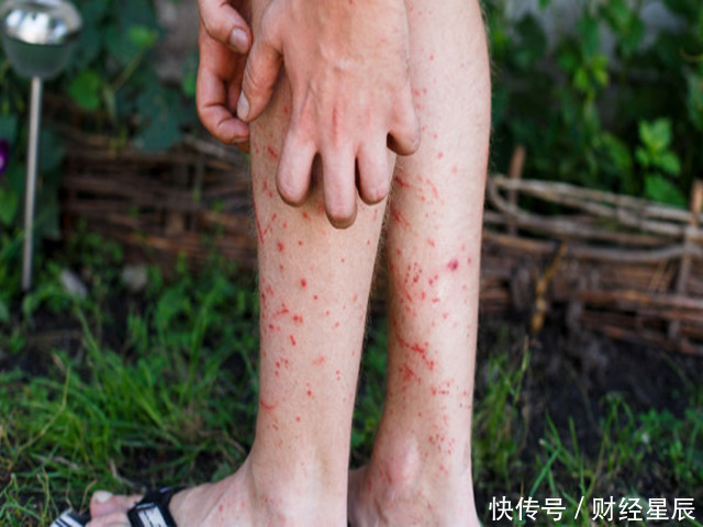 肝坏一身毒!肝不好了,通常有5个异常,希望你一个也没有