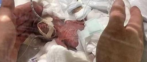 身体机能|母亲在怀孕期间长时间没有体重增加,婴儿只有268克,成为世界上最小的男孩