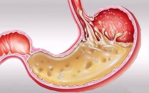 肢端肥大症|糖尿病还有“假”？建议：若有这3种情况，就是”假性糖尿病“！