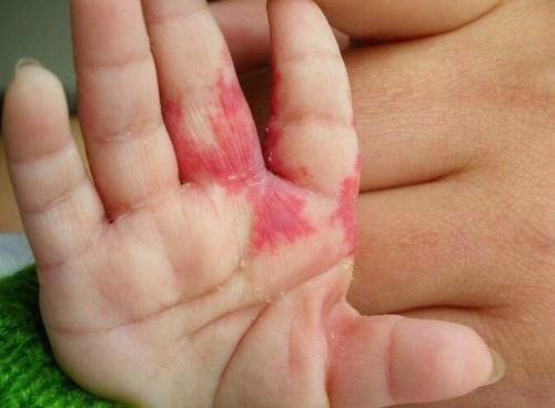 胎儿|孕妈吃酱油会让胎儿脸上长胎记？孕期做好这几项防护，让胎记远离