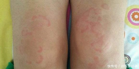 简明中医皮肤病学|总起“风疹块”，就是脾虚一张治慢性荨麻疹的医案，请认真体会