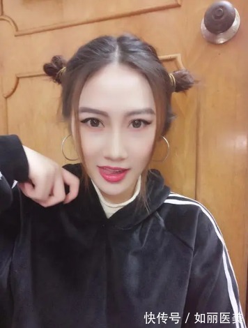 褶皱 做完双眼皮手术后老气?这2个因素帮你盘点盘点