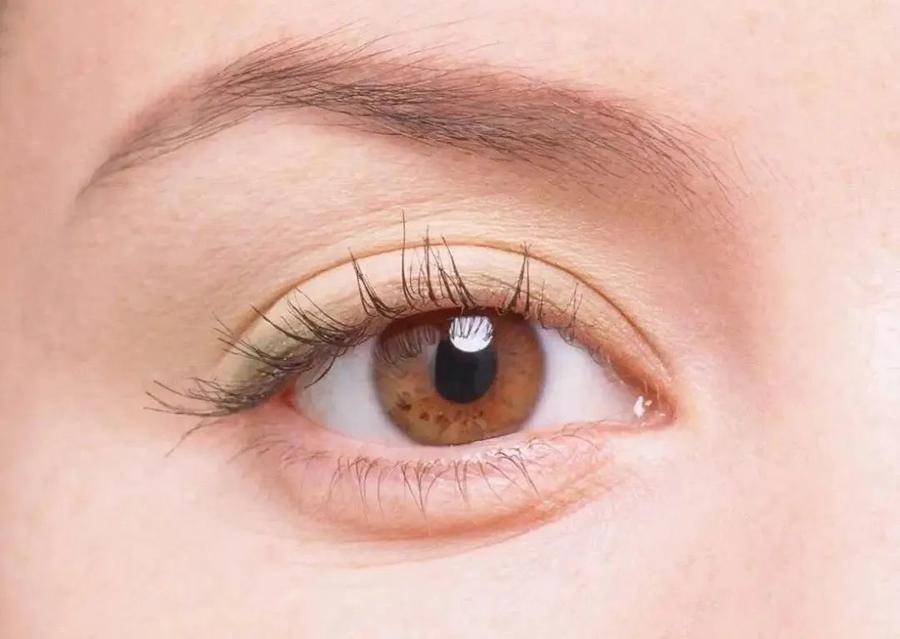 瘢痕 什么时候适合做双眼皮修复手术?必须要等6个月之后才能做吗?