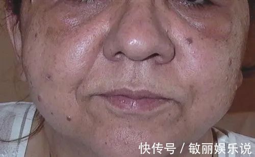 忠告|为什么肺癌越来越多?忠告:少惹三种“气”,头部3个表现要就医