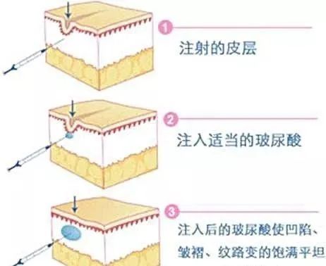 折纹|你的脖子比脸更显老，出现颈纹该怎么去除？丨科普篇