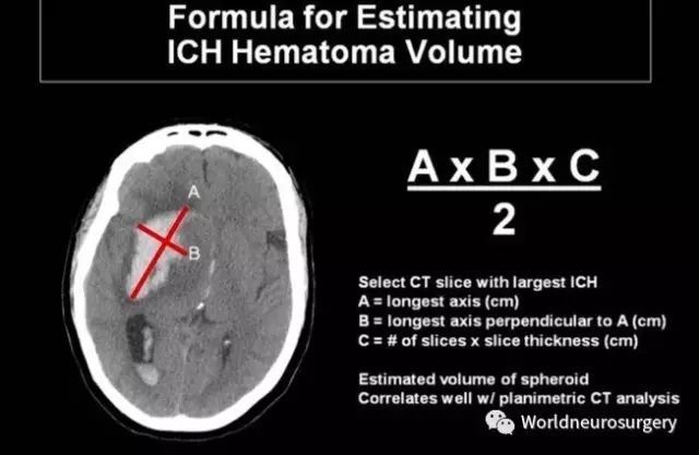 颅内血肿|颅内血肿体积计算公式~超级实用